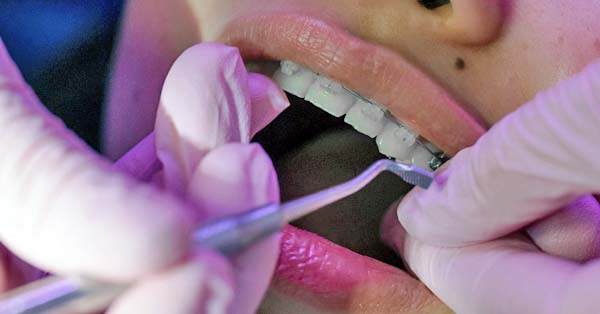 Can I Wear Braces After Root Canal Procedure?
