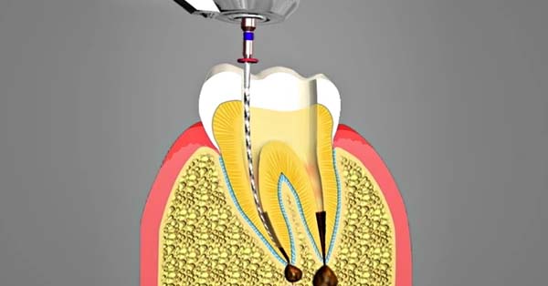 Can You Affix Root Canal if You Have Braces? | Redwood City